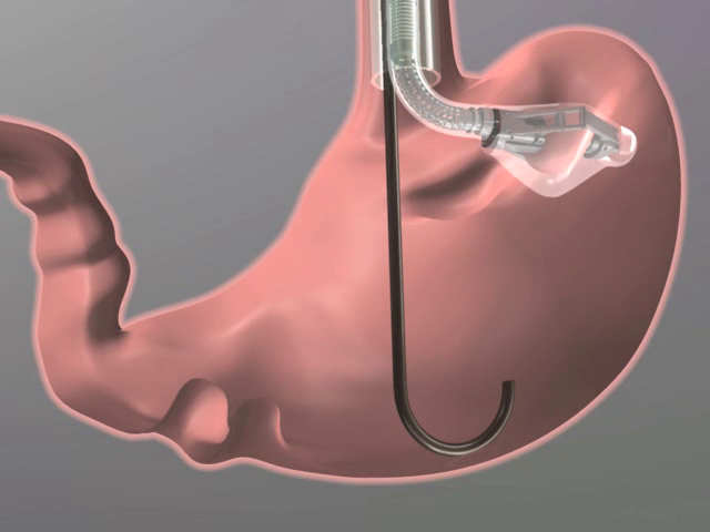 Figure 1: gastroscopically plicating the stomach